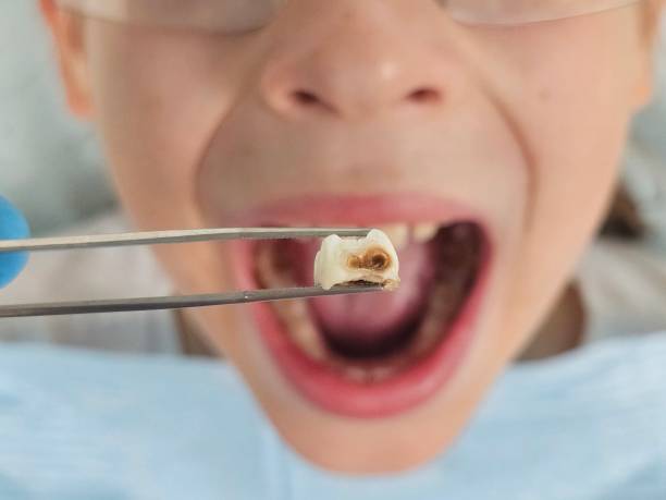 Best Emergency Root Canal Treatment in Brownsville, TX